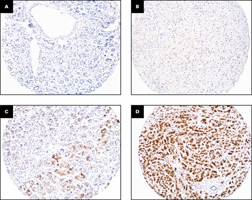 Glypican-3 immunohistochemistry in hepatocellular carcinoma (×100). A, Negative. B, 1+. C, 2+. D, 3+.