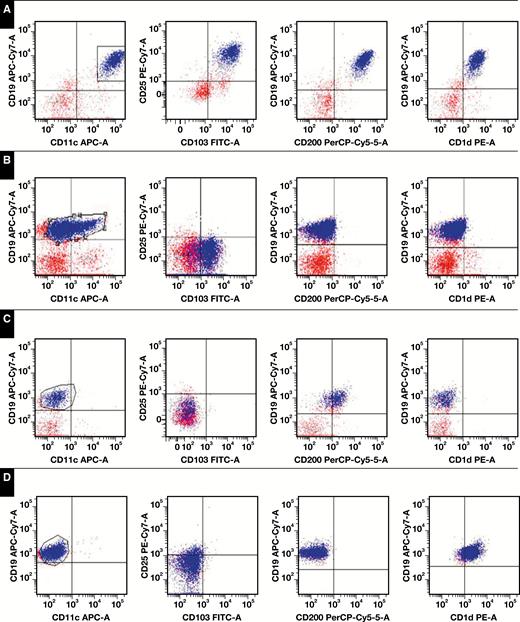 CD200 and CD1d expression in CD19+ B cells in CD10–, CD5– B-cell lymphoproliferative disorders. A, Brightly positivity CD200 expression and positive CD1d expression in hairy cell leukemia (HCL), along with positive expression of CD11c, CD25, and CD103. B, CD19+ B cells in hairy cell leukemia-variant (HCL-v) are negative for CD200 and CD1d as well as for CD25 but positive for CD11c and CD103. C, Lymphoplasmacytic lymphoma (LPL) shows positive staining for CD200 and negative staining for CD1d and is negative for CD11c, CD25, and CD103. D, Negative CD200 staining with positive CD1d expression in a case of marginal zone lymphoma (MZL), which was also negative for CD11c, CD25, and CD103. APC, allophycocyanin; Cy, cyanine; FITC, fluorescein isothiocyanate; PE, R-phycoerythrin; PerCP, peridinin chlorophyll.